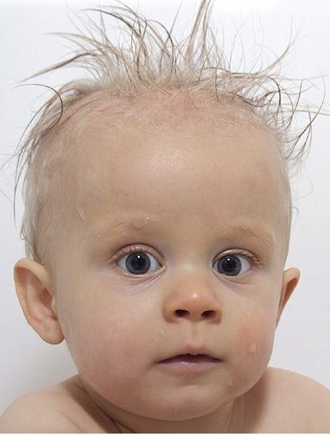 Что делать, если ваш ребенок начинает терять волосы?