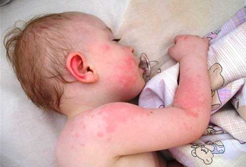Главные причины детской аллергии