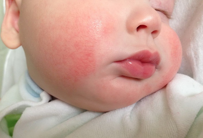 Как предотвратить аллергию у ребенка
