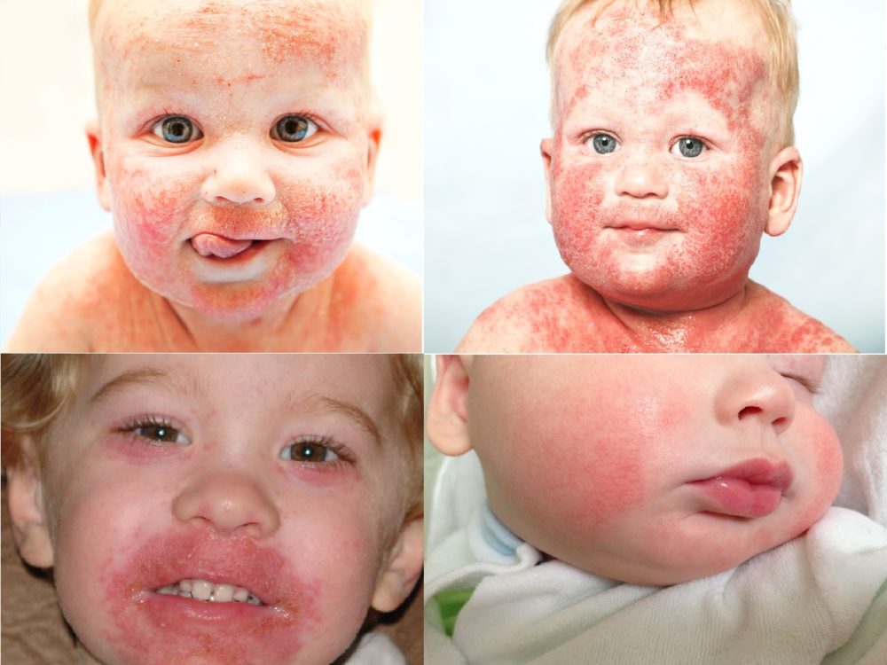 Как справиться с аллергией у ребенка: симптомы и лечение