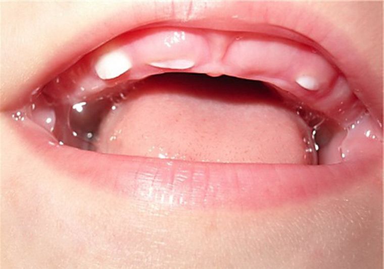 Какие симптомы зубной боли у грудничка