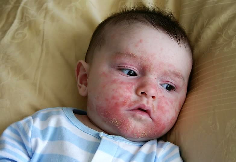 Лечение аллергии у ребенка