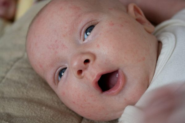 Тестирование на аллергию у детей